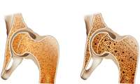  پوکی استخوان، یک بیماری خاموش و مزمن است